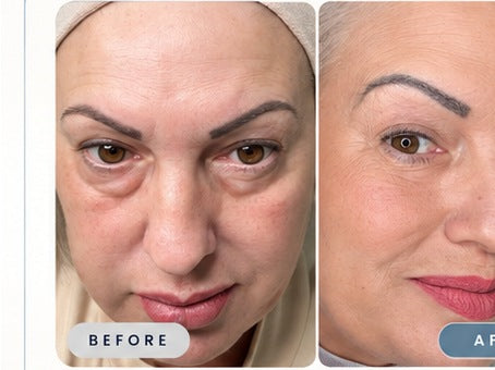 Lily before and after, showing softer looking fine lines around the eyes