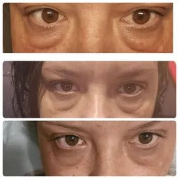 A customer's eye area, day one and day ten