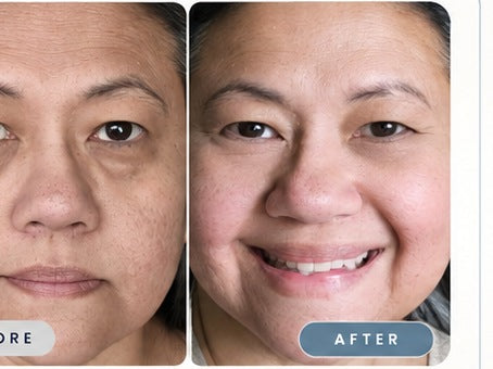 Gabrielle before and after, showing smoother looking under-eye skin