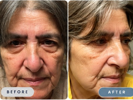 Mildred before and after, showing a brighter looking eye area