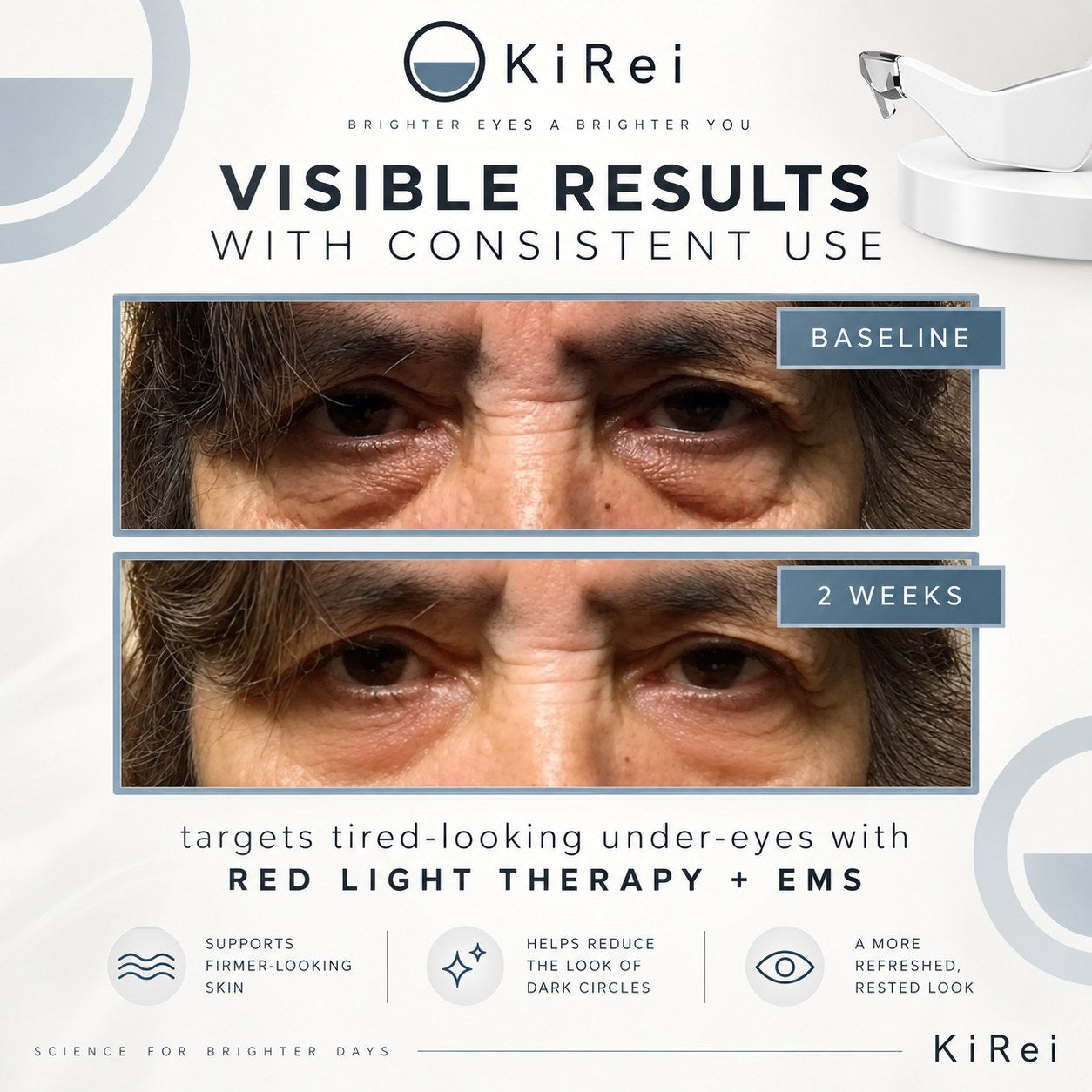A baseline and two week comparison of a customer's under-eye area